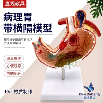 Демонстрация патологической язвы желудка / язвы на модели желудка с поперечной перегородкой